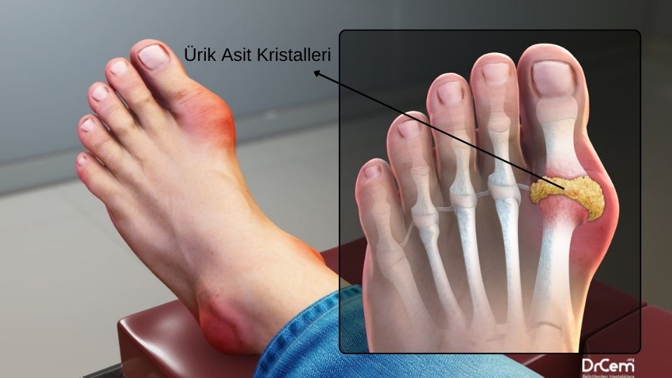Gut Hastalığı görseli - DrCem hastalık rehberi
